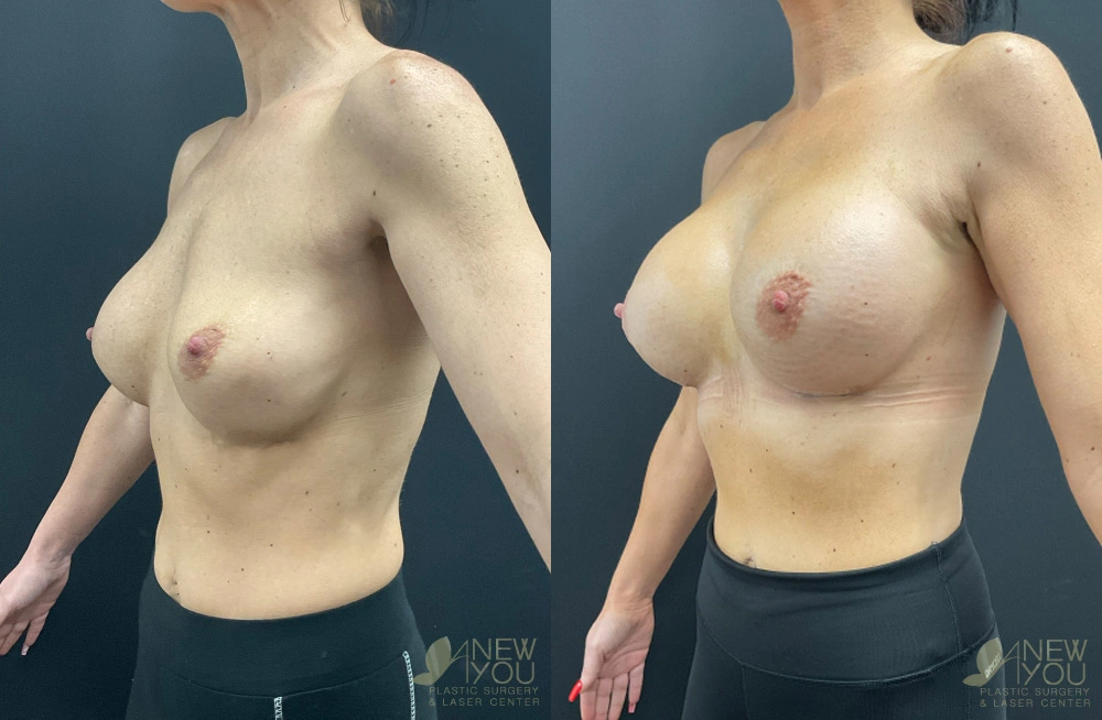 Real Patient Results by Dr. Shah of A New You Plastic Surgery & Medical Spa in Chicago, IL