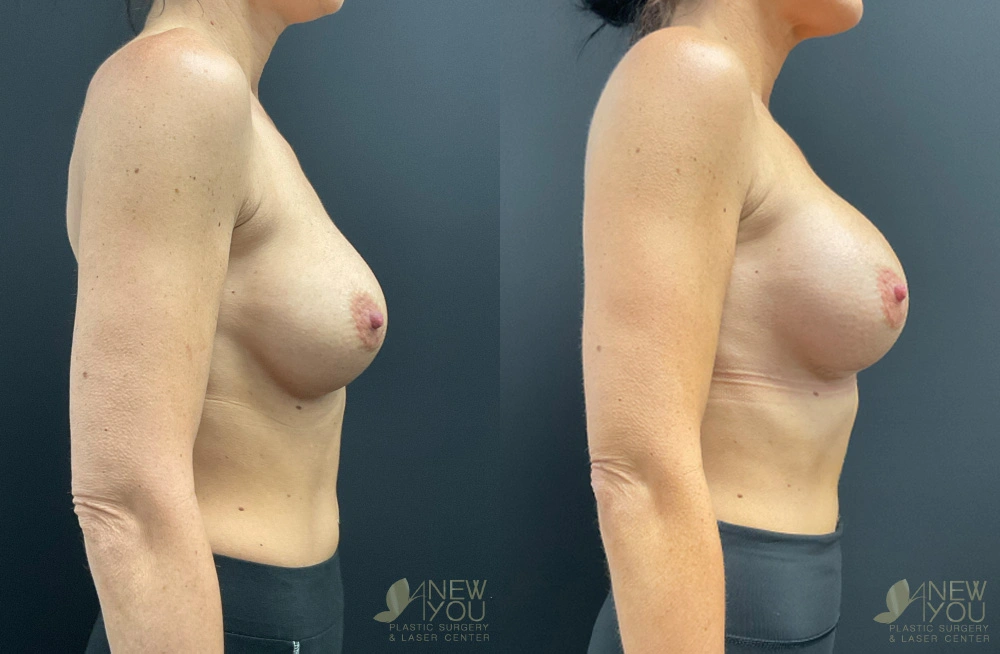 Real Patient Results by Dr. Shah of A New You Plastic Surgery & Medical Spa in Chicago, IL