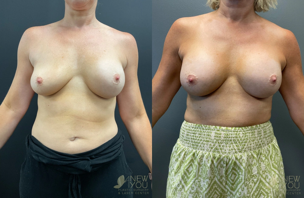 Real Patient Results by Dr. Shah of A New You Plastic Surgery & Medical Spa in Chicago, IL