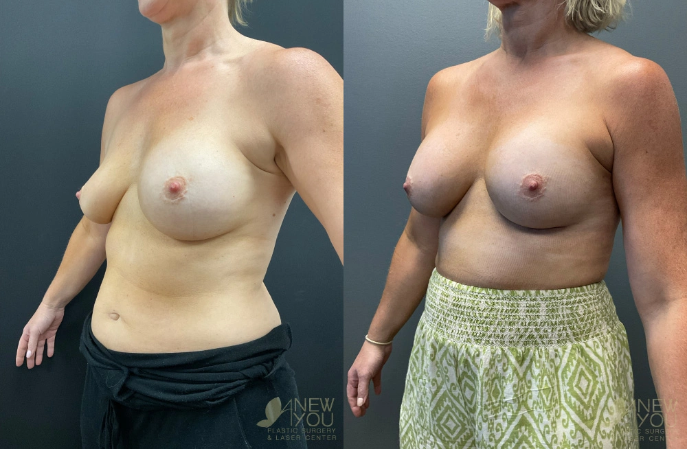 Real Patient Results by Dr. Shah of A New You Plastic Surgery & Medical Spa in Chicago, IL