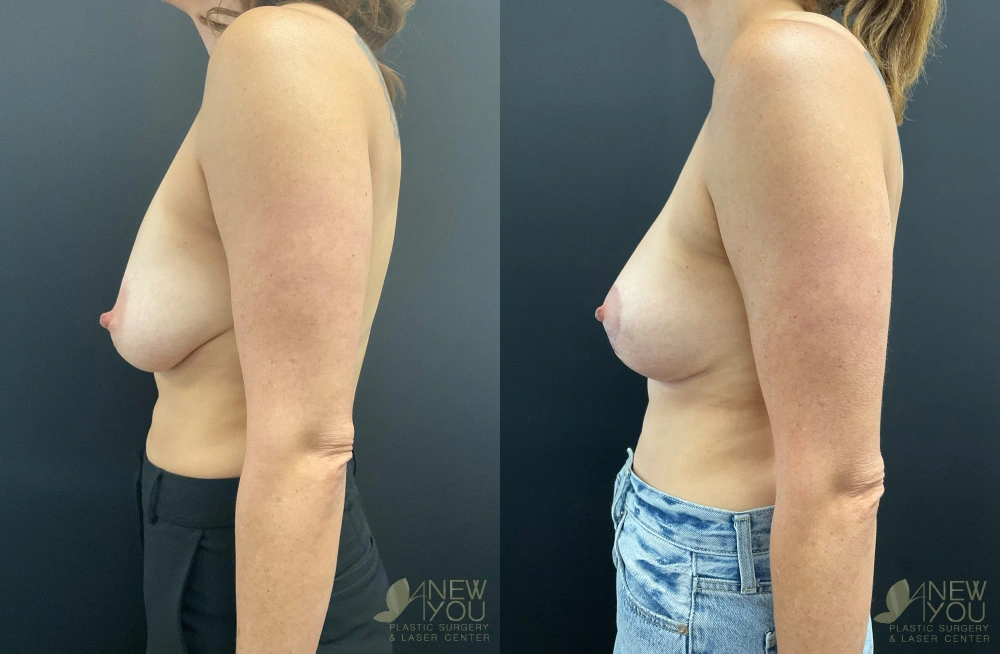 Real Patient Results by Dr. Shah of A New You Plastic Surgery & Medical Spa in Chicago, IL