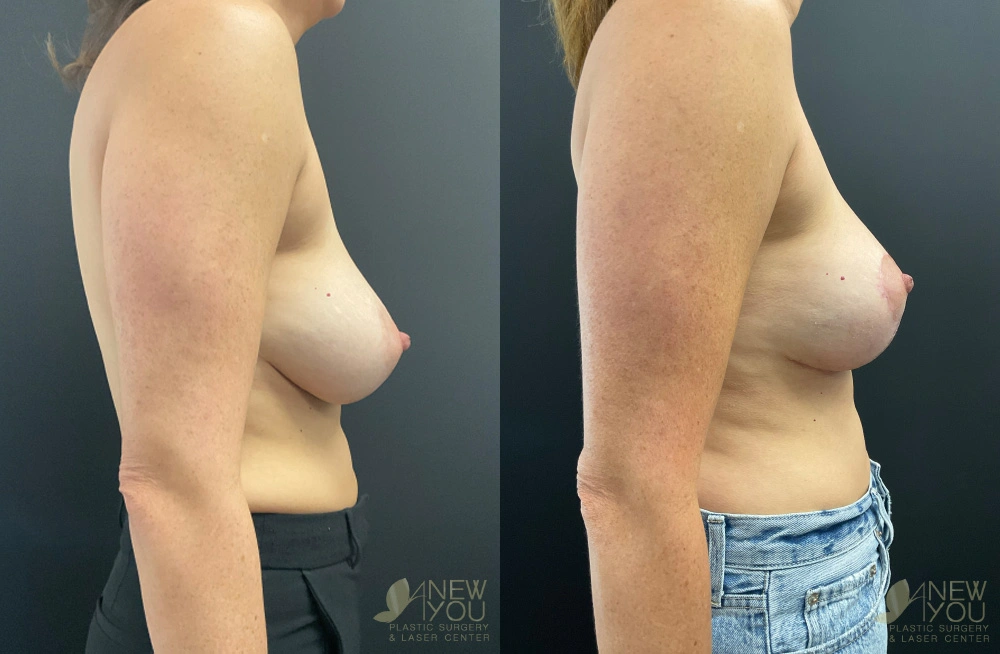 Real Patient Results by Dr. Shah of A New You Plastic Surgery & Medical Spa in Chicago, IL