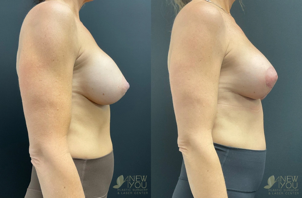 Real Patient Results by Dr. Shah of A New You Plastic Surgery & Medical Spa in Chicago, IL