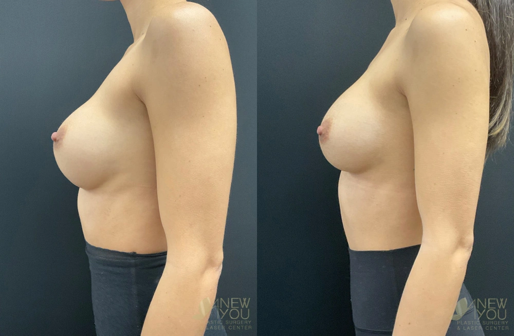 Real Patient Results by Dr. Shah of A New You Plastic Surgery & Medical Spa in Chicago, IL
