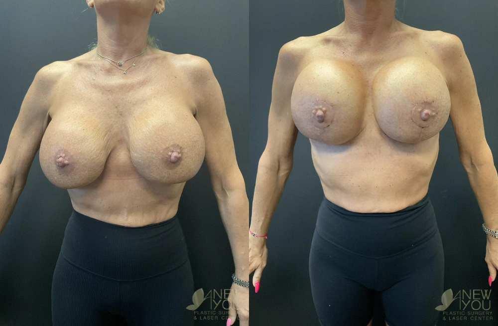 Real Patient Results by Dr. Shah of A New You Plastic Surgery & Medical Spa in Chicago, IL