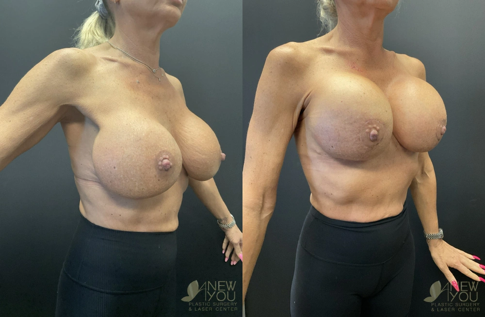 Real Patient Results by Dr. Shah of A New You Plastic Surgery & Medical Spa in Chicago, IL