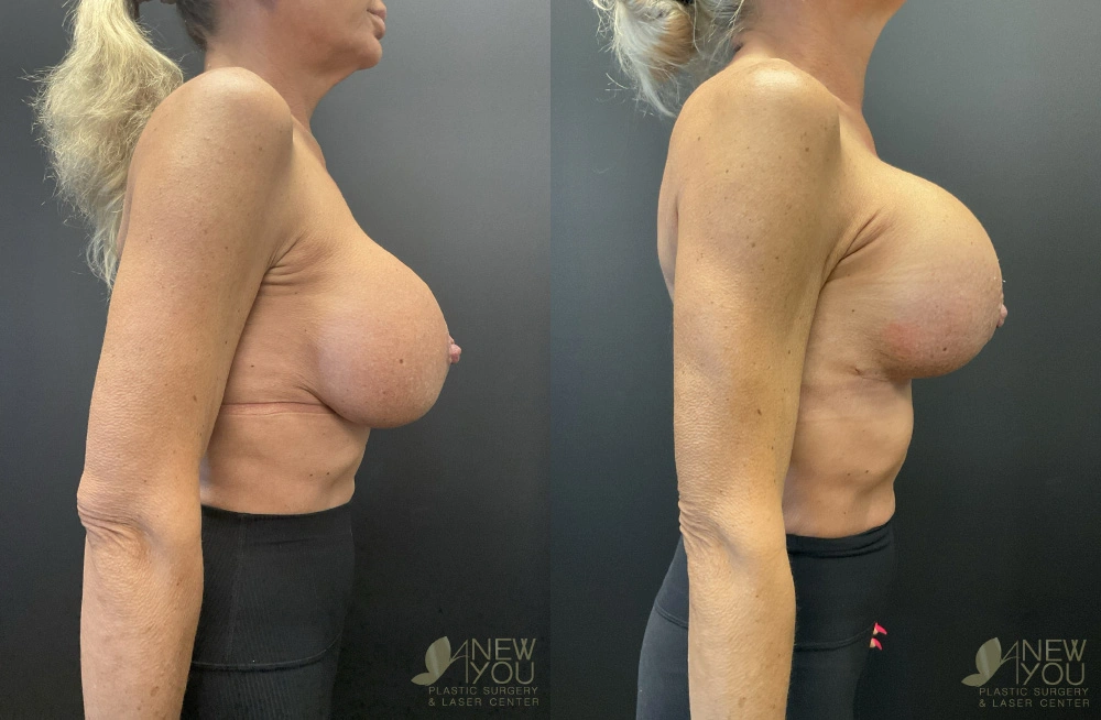 Real Patient Results by Dr. Shah of A New You Plastic Surgery & Medical Spa in Chicago, IL