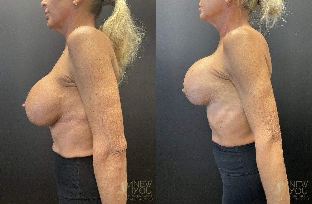 Real Patient Results by Dr. Shah of A New You Plastic Surgery & Medical Spa in Chicago, IL