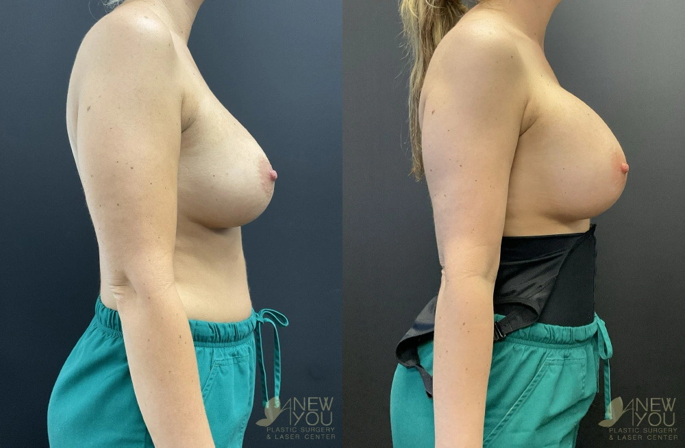 Real Patient Results by Dr. Shah of A New You Plastic Surgery & Medical Spa in Chicago, IL