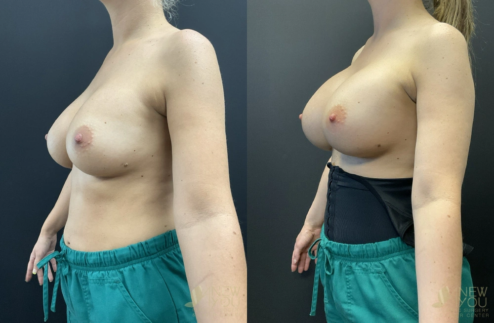 Real Patient Results by Dr. Shah of A New You Plastic Surgery & Medical Spa in Chicago, IL