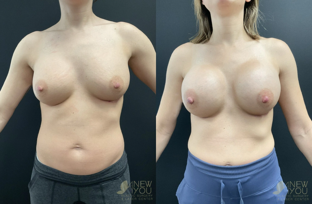 Real Patient Results by Dr. Shah of A New You Plastic Surgery & Medical Spa in Chicago, IL