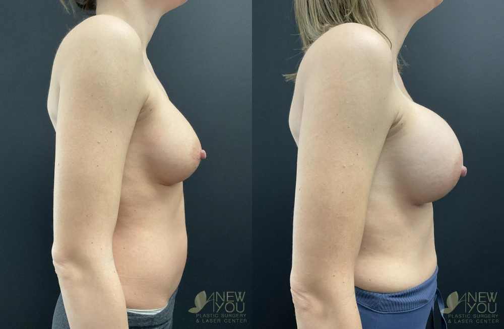 Real Patient Results by Dr. Shah of A New You Plastic Surgery & Medical Spa in Chicago, IL