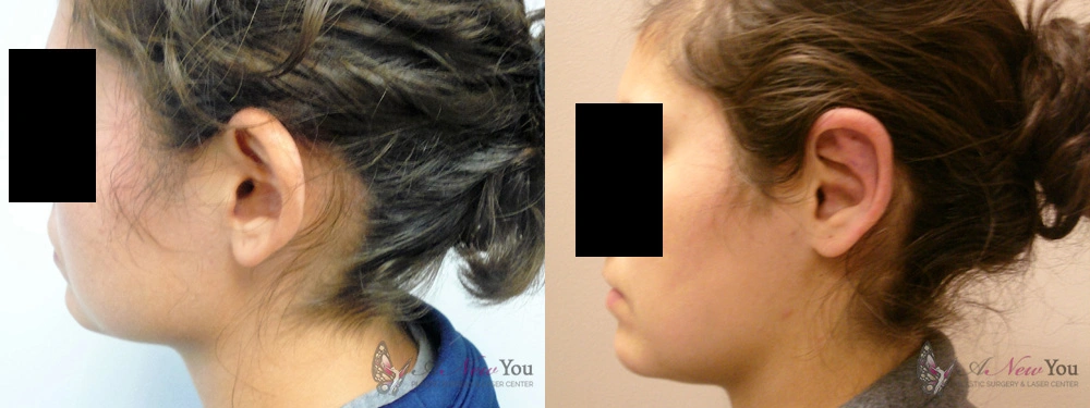 Real Patient Results by Dr. Shah of A New You Plastic Surgery & Medical Spa in Chicago, IL