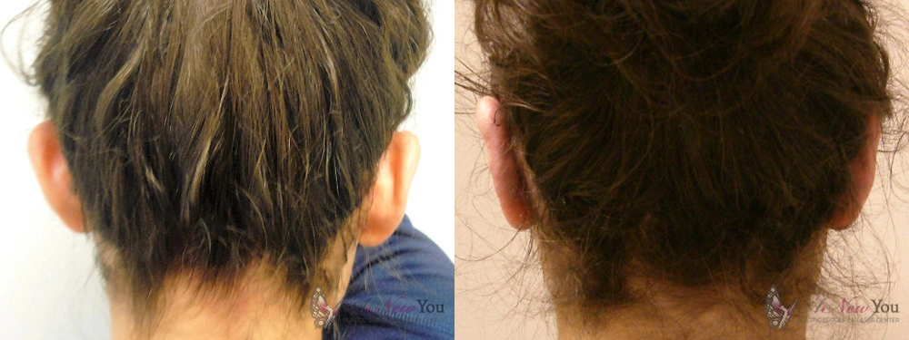 Real Patient Results by Dr. Shah of A New You Plastic Surgery & Medical Spa in Chicago, IL