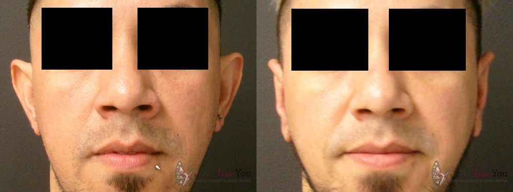 Real Patient Results by Dr. Shah of A New You Plastic Surgery & Medical Spa in Chicago, IL