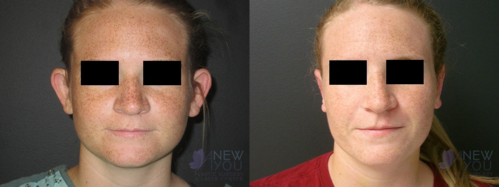 Real Patient Results by Dr. Shah of A New You Plastic Surgery & Medical Spa in Chicago, IL