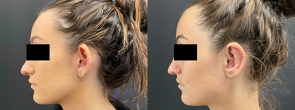 Real Patient Results by Dr. Shah of A New You Plastic Surgery & Medical Spa in Chicago, IL