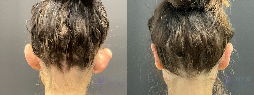 Real Patient Results by Dr. Shah of A New You Plastic Surgery & Medical Spa in Chicago, IL