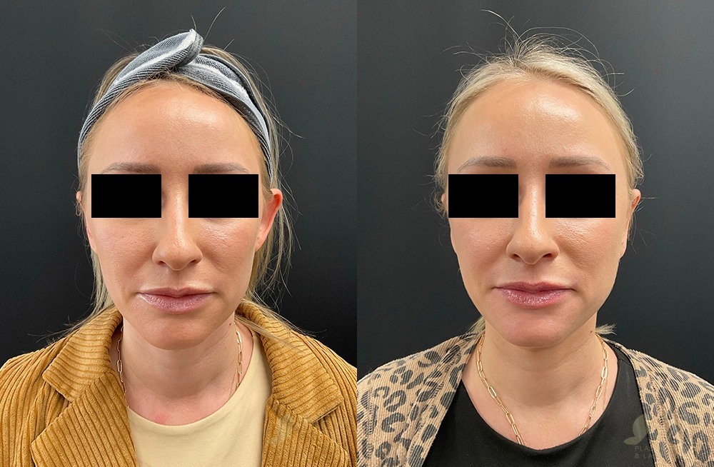 Real Patient Results by Dr. Shah of A New You Plastic Surgery & Medical Spa in Chicago, IL