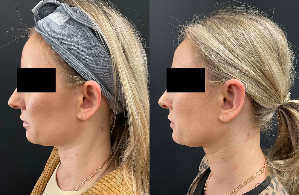 Real Patient Results by Dr. Shah of A New You Plastic Surgery & Medical Spa in Chicago, IL
