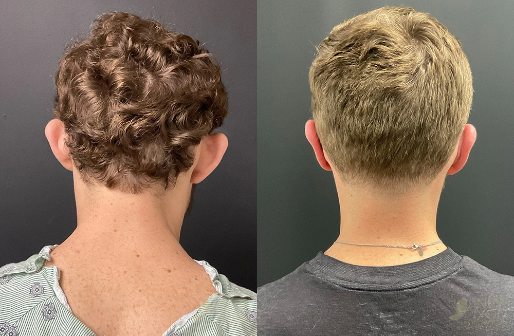 Real Patient Results by Dr. Shah of A New You Plastic Surgery & Medical Spa in Chicago, IL