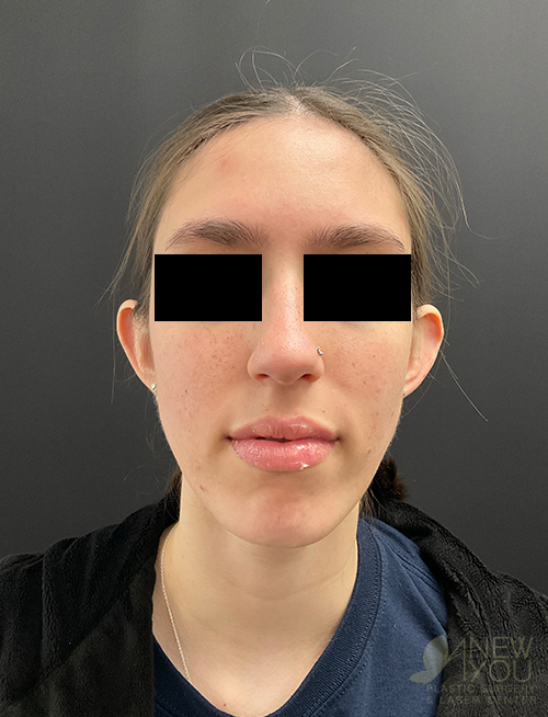 ear-reshaping-08a-before