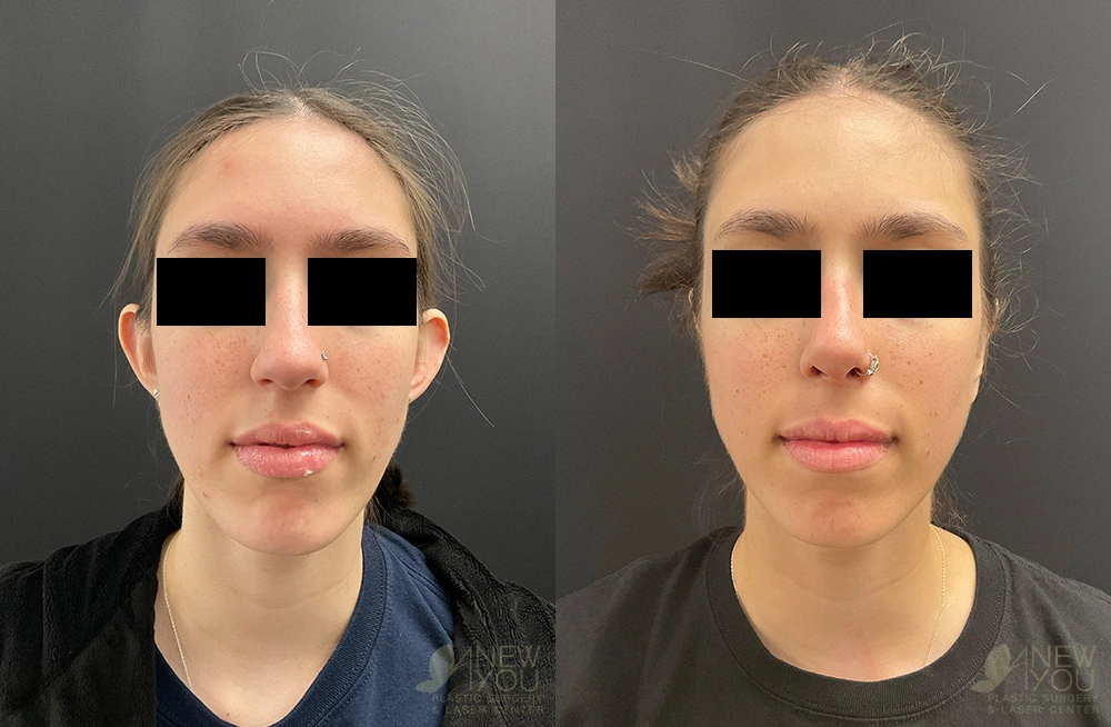 Real Patient Results by Dr. Shah of A New You Plastic Surgery & Medical Spa in Chicago, IL