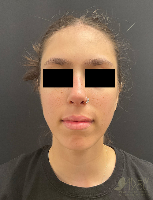 ear-reshaping-08a-post