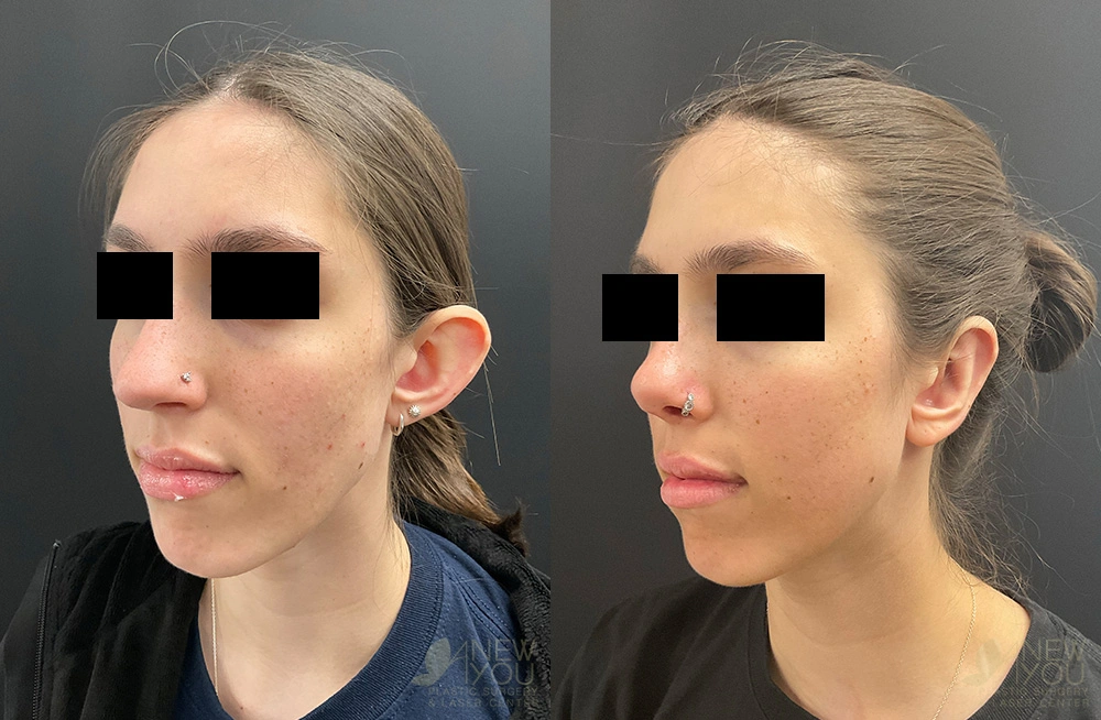 Real Patient Results by Dr. Shah of A New You Plastic Surgery & Medical Spa in Chicago, IL