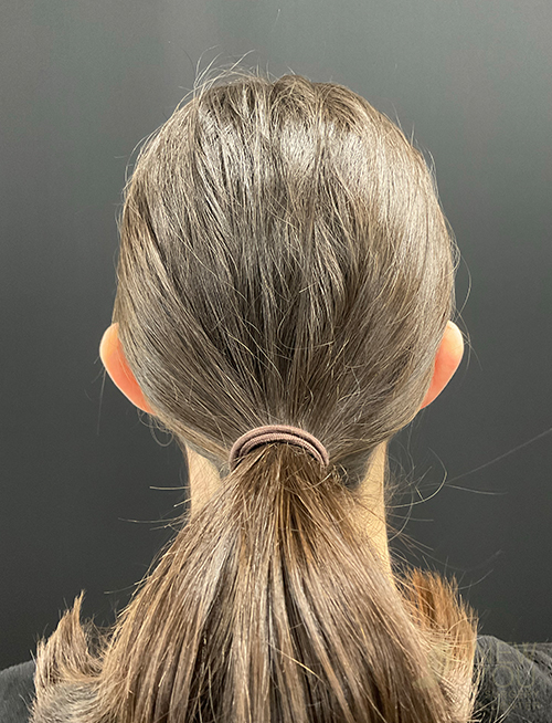 ear-reshaping-08c-before