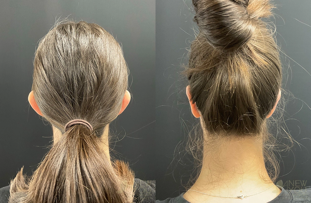 Real Patient Results by Dr. Shah of A New You Plastic Surgery & Medical Spa in Chicago, IL