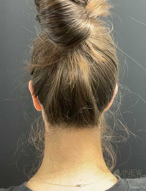 ear-reshaping-08c-post