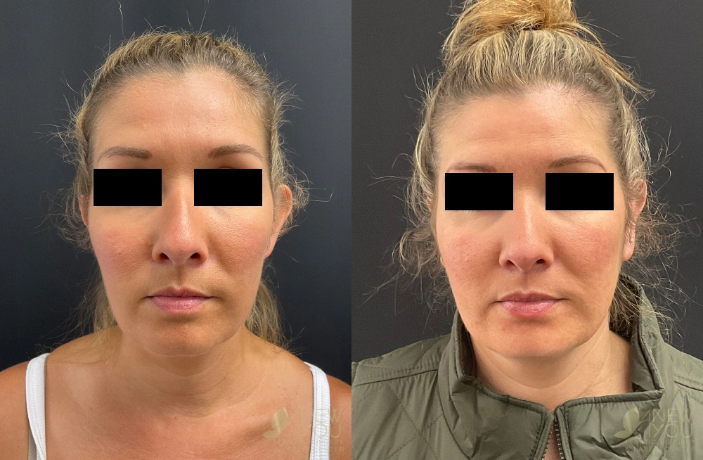 Real Patient Results by Dr. Shah of A New You Plastic Surgery & Medical Spa in Chicago, IL