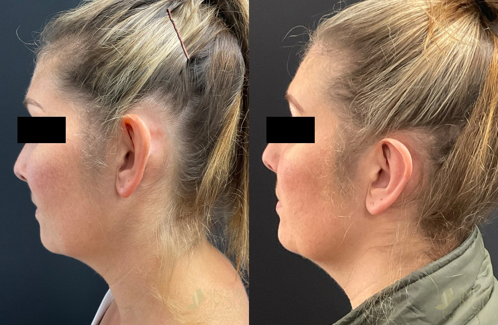Real Patient Results by Dr. Shah of A New You Plastic Surgery & Medical Spa in Chicago, IL