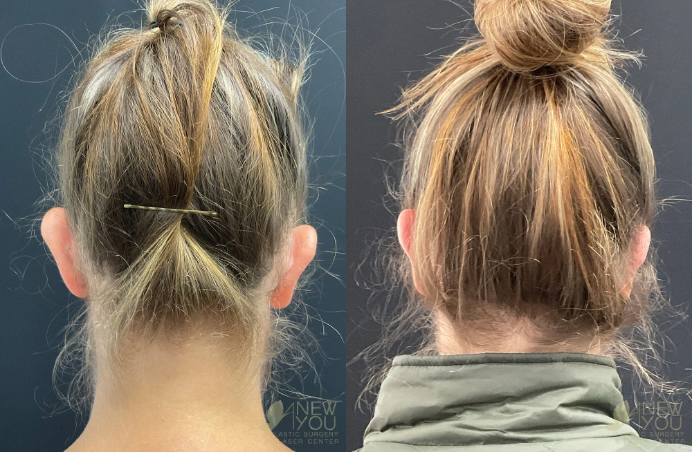 Real Patient Results by Dr. Shah of A New You Plastic Surgery & Medical Spa in Chicago, IL