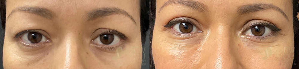 Real Patient Results by Dr. Shah of A New You Plastic Surgery & Medical Spa in Chicago, IL