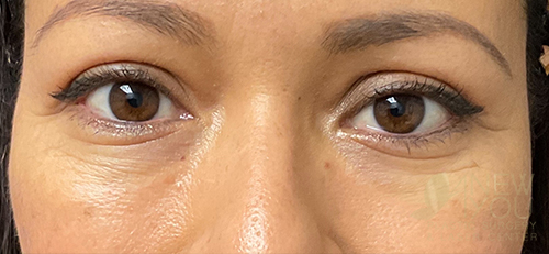 eyelid-lift-01a-post