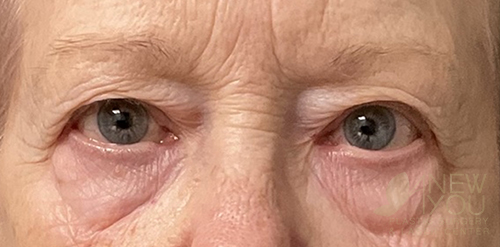 eyelid-lift-02a-before