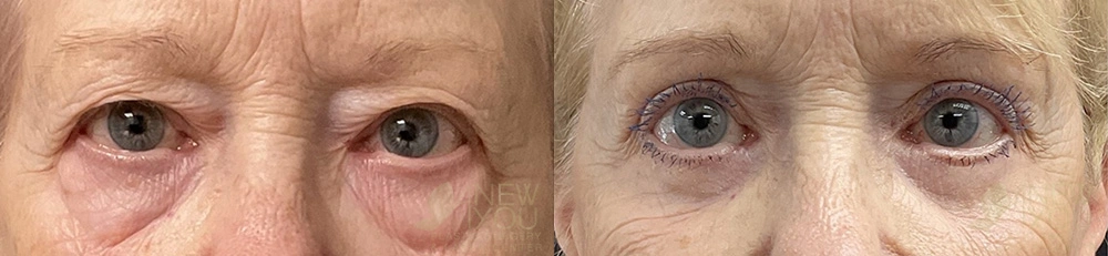 Real Patient Results by Dr. Shah of A New You Plastic Surgery & Medical Spa in Chicago, IL