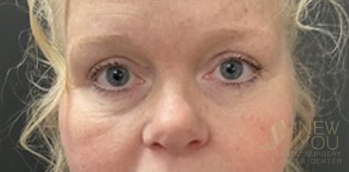 eyelid-lift-03a-post