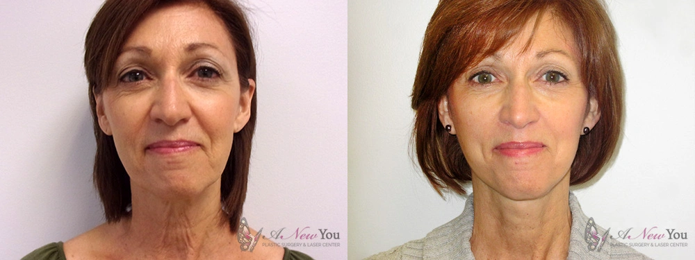 Real Patient Results by Dr. Shah of A New You Plastic Surgery & Medical Spa in Chicago, IL
