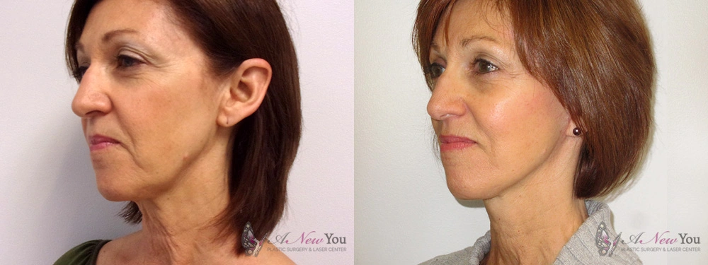Real Patient Results by Dr. Shah of A New You Plastic Surgery & Medical Spa in Chicago, IL