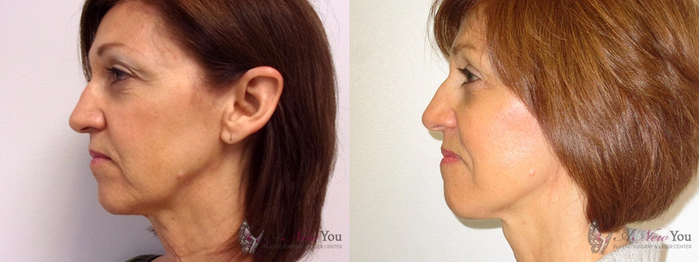 Real Patient Results by Dr. Shah of A New You Plastic Surgery & Medical Spa in Chicago, IL