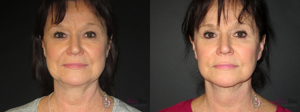 Real Patient Results by Dr. Shah of A New You Plastic Surgery & Medical Spa in Chicago, IL