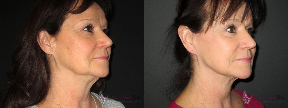 Real Patient Results by Dr. Shah of A New You Plastic Surgery & Medical Spa in Chicago, IL