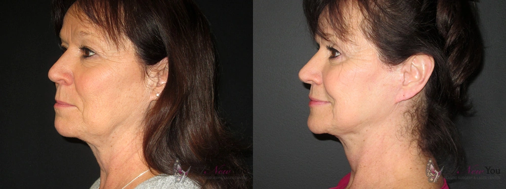 Real Patient Results by Dr. Shah of A New You Plastic Surgery & Medical Spa in Chicago, IL