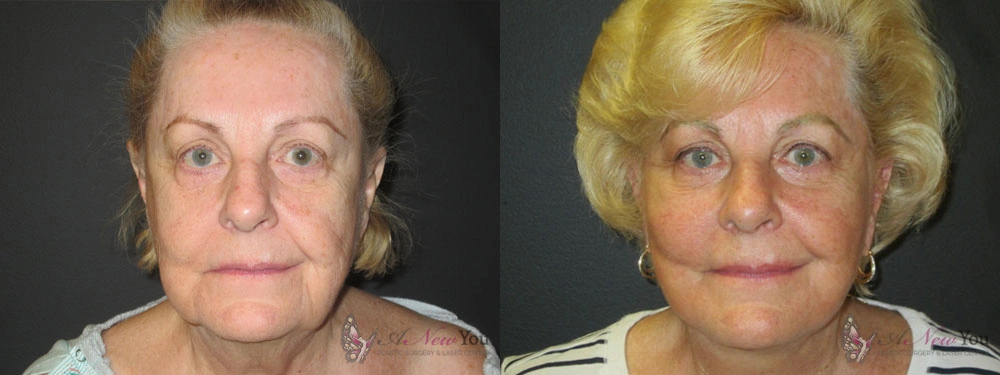 Real Patient Results by Dr. Shah of A New You Plastic Surgery & Medical Spa in Chicago, IL