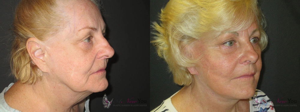 Real Patient Results by Dr. Shah of A New You Plastic Surgery & Medical Spa in Chicago, IL