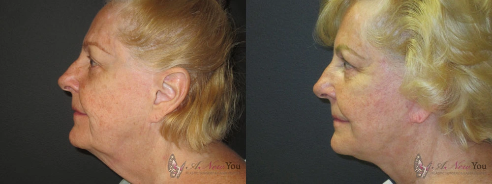 Real Patient Results by Dr. Shah of A New You Plastic Surgery & Medical Spa in Chicago, IL
