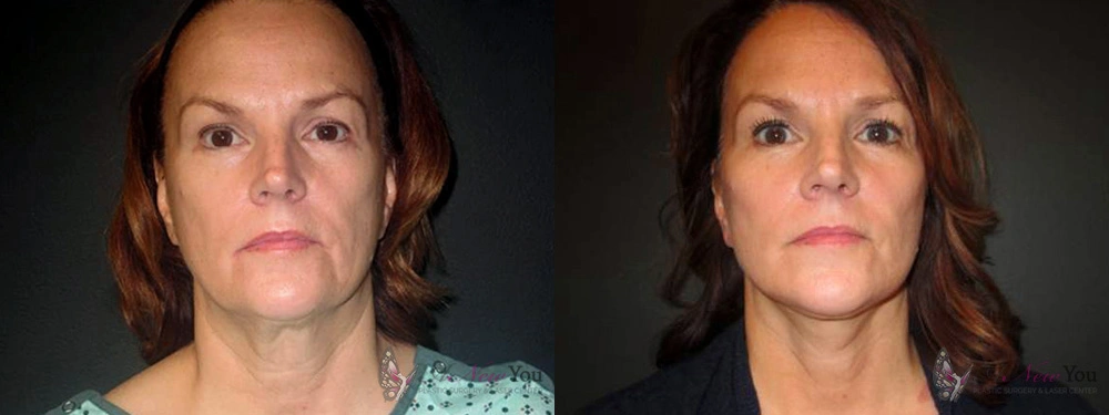 Real Patient Results by Dr. Shah of A New You Plastic Surgery & Medical Spa in Chicago, IL